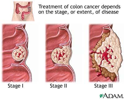 Colon cancer TCM Anti-Cancer Centre Zhao Cheng R.TCMP, R.Ac., Ph.D. Stages of cancer The staging of a carcinoma has to do with the size of the tumor, and the degree to which it has penetrated.