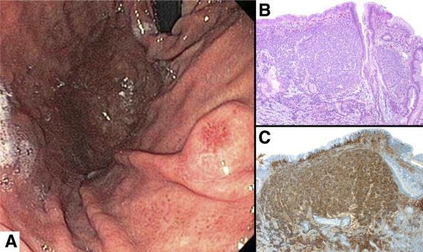 Figure 7. Gastric neuroendocrine tumor. (A) A small gastric carcinoid with surface ulceration seen on retroflexion in the distal body.