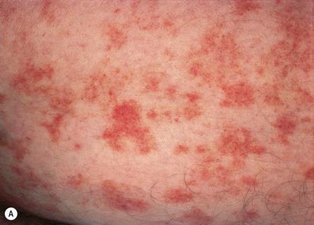 Schamberg's Disease Yellow-brown patches with an oval to irregular outline, pinpoint petech Most common form, peak frequency in