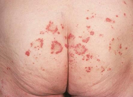 Purpura annularis telangiectodes of Majocchi Uncommon, adolescents, young adults, especially women 1-3 cm annular plaques that slowly expand,