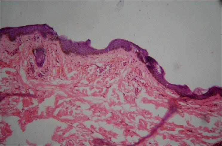Pathology Histopathology may show hemorrhage, a mild perivascular infiltrate, or a leukocytoclastic vasculitis Image shows