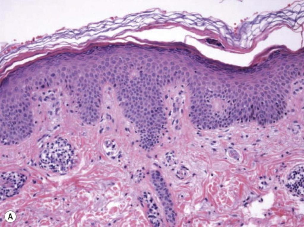 Pathology Superficial lesions: mild spongiosis, focal parakeratosis, superficial perivascular lymphohistiocytic infiltrate Fairly tight aggregates around vessels, the so-called coat sleeve