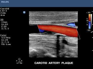The size and location of plaque and blood flow in the carotid artery are easily
