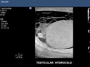 PureWave on the C9-3v transducer provides exceptional clarity of uterine anatomy with