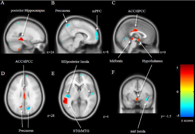 Decreased Regional Gray Matter Density in Patients with Cyclic Menstrual Pain R medial frontal