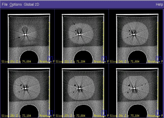 Volume Calculations and Distance Measurements TRUS calculation of prostate volume in prostate phantom agrees with treatment planning computer calculation to within 1% TRUS