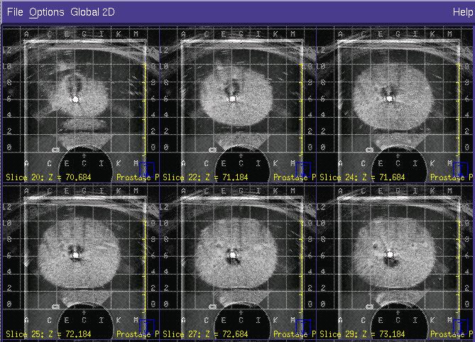 Agreement of Grid Point with Needle Template Holes - Fusion with CT image Fusion of