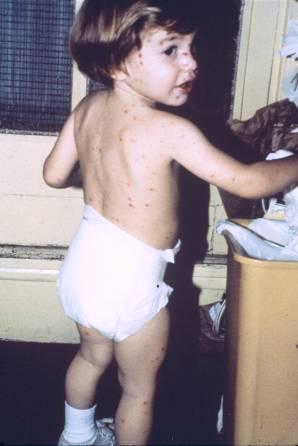 Natural History of VZV Primary infection: varicella Highly contagious (airborne) Complications: bacterial superinfection, encephalitis, pneumonia, congenital syndrome Secondary infection: zoster