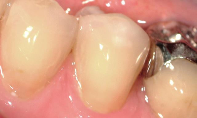 immediately after dispensing/placing the glass ionomer in the restoration.