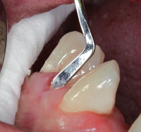 fluorescence of a natural tooth, perfecting the naturally esthetic