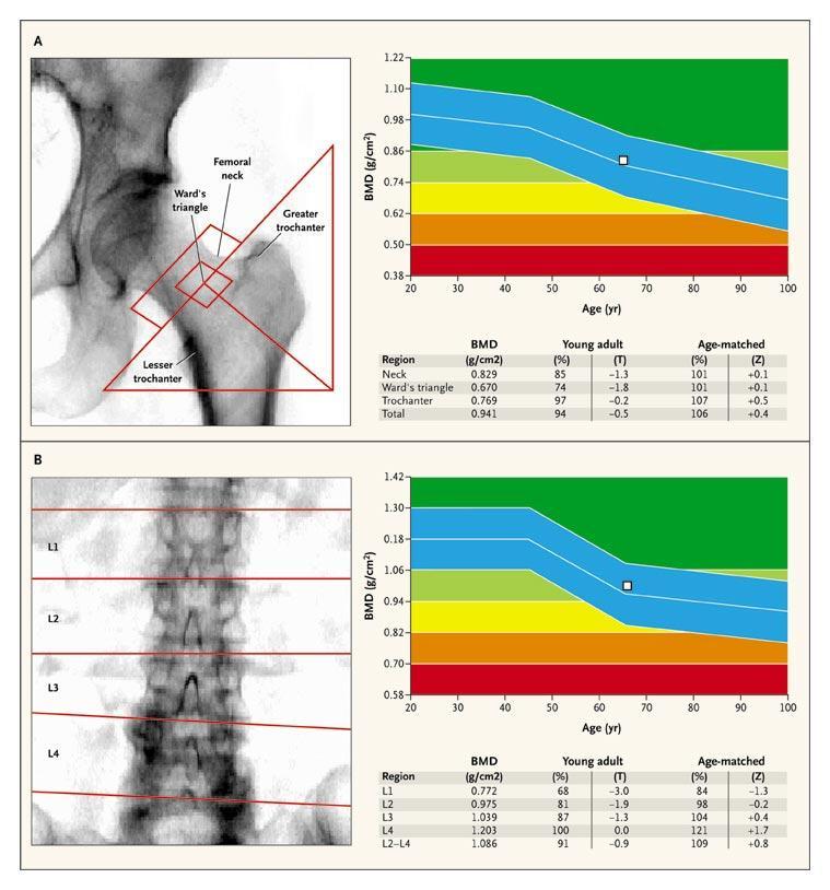 BMD measurement: 1. Dual-Energy X-Ray Absorptiometry: Results expressed as T-SCORE is the number of SD the measurement is above or below the YOUNG-NORMAL MEAN BMD.