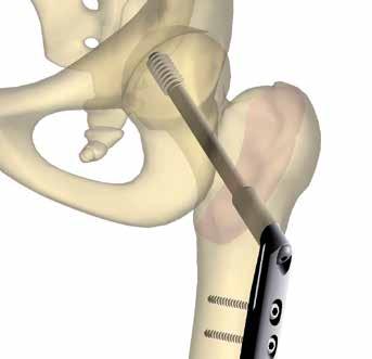 18. Check implant position Implant extraction It is important to ensure that the Lag Screw is placed within the femoral head.