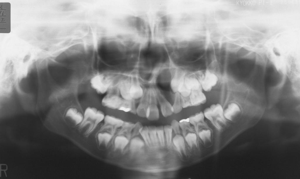 MAXILLARY EXPANSION AND PROTRACTION IN