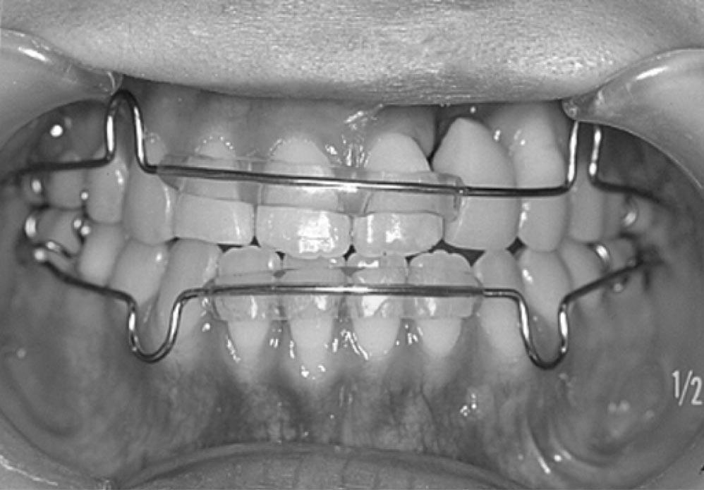 formed at 14 years and 4 months of age to aid in the stabilization of the maxillary arch length, width, and symmetry. Nose and lip revisions were performed the following year.
