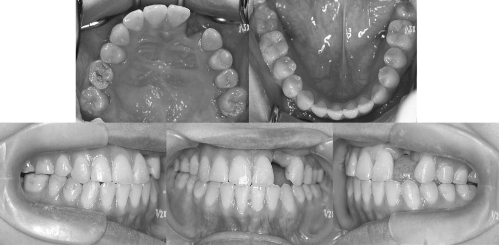 MAXILLARY EXPANSION AND PROTRACTION IN CLEFT LIP/PALATE 359 FIGURE 8. Intraoral photographs at the retention phase. FIGURE 9. Facial photographs after active treatment.