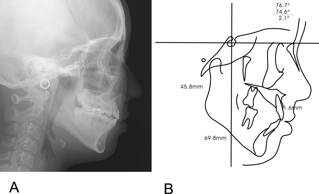 The measurement of mandibular height revealed a marked vertical growth of 4.7 mm at Ar-Me, whereas no substantial growth of the maxilla was seen (Figure 12; Table 1).