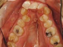 dentition in good health with some restorations