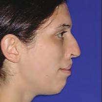 presented with a bilateral cleft lip and palate, mobile