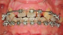 maxillary incisors.
