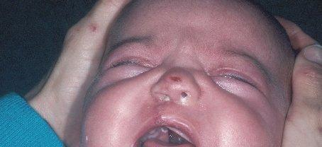 clefts in hard palates may affect facial bone growth