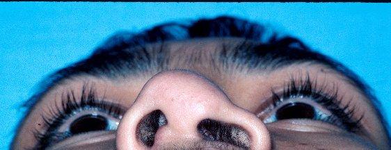 Bilateral cleft lip