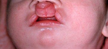 clefts as part of syndromes Cleft Overview Fetal origins Cleft