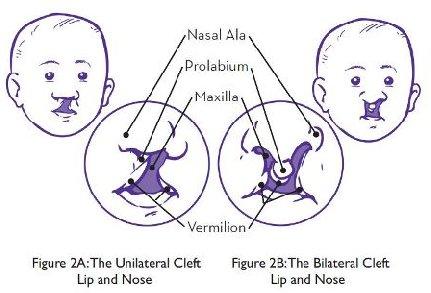 palate alone occurs in 1/1000 births Cleft lip more common in