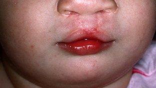 Cleft Lip Open Spine and/or Water on the Brain Down Syndrome