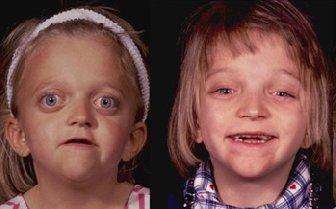 Before and After - Crouzon Apert syndrome