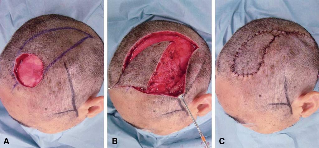 Superficial temporal facia pedicle VY advancement scalp flap 677 Figure 1 (a) Defect and design of the superficial temporal fascia pedicle VY advancement scalp flap based on the superficial temporal