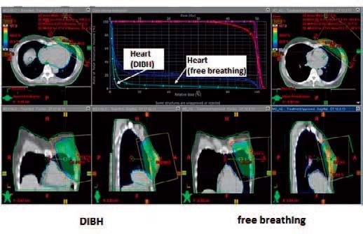 Goal: Heart Dose Zero Deep Inspiration Breath Hold (DIBH) Respiratory