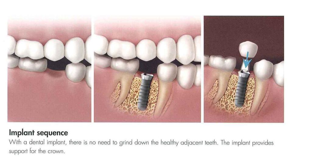Healing From Your Dental Implant When it comes to healing with your new implant, it can oftentimes be easier than other, more common dental procedures.