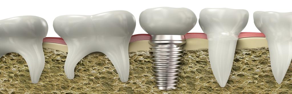 What Are Dental Implants? Dental implants offer a lasting solution to any broken or missing that you may be experiencing.