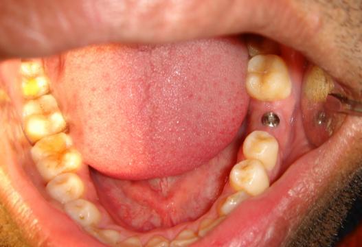 CONDITION DENTAL IMPLANT IN PLACE
