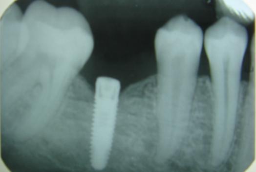 DENTAL IMPLANT IMPLANT TOOTH FEELS