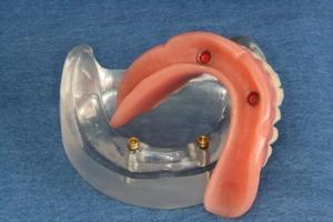 OPTIONS FOR ALL TEETH MISSING: OPTION 1: Snap-On Denture (Semi Fixed Type 1) It can be done with as few as two