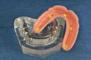 OPTIONS FOR ALL TEETH MISSING OPTION 2: Removable Bridge (Semi fixed Type 2) This is an upgrade from the "snap-on denture.