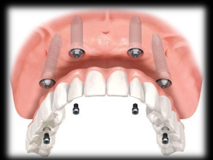 OPTIONS FOR ALL TEETH MISSING OPTION 3: Fixed Implant Hybrids (Fixed Type 1) These are another choice,