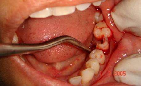 EXTRACTION OF BROKEN TOOTH AND