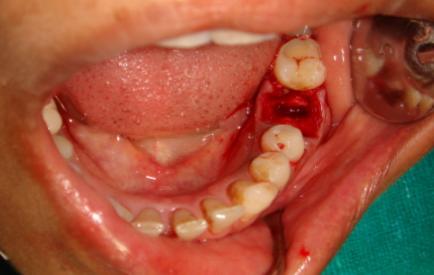 PRETREATMENT CONDITION TOOTH BEING