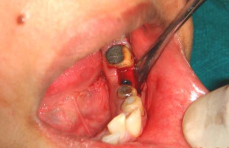 SIMULTANEOUSLY HEALED IMPLANT TOOTH