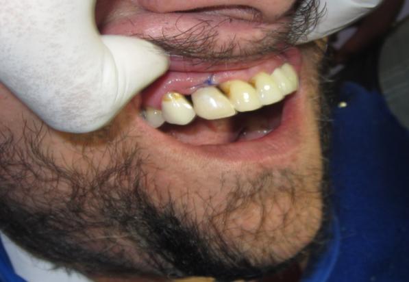 The implant was placed (as depicted in the first picture) in the area where the tooth was missing and simultaneously a temporary (cosmetic) tooth was given at