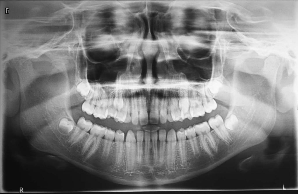 MAXILLARY TRANSPOSITION 515 Figure 8. Panoramic radiograph showing a complete Mx.C.P1 bilateral transposition.