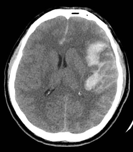 RUPTURED MIDDLE CEREBRAL ARTERY ANEURYSM WITH INTRASYLVIAN HEMATOMA Table 2.