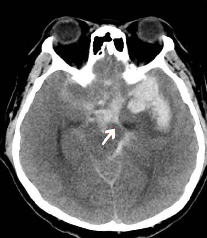 DAL-SUNG RYU ET AL Intrasylvian hematoma was very sticky, and could not be removed by simple suction and irrigation.