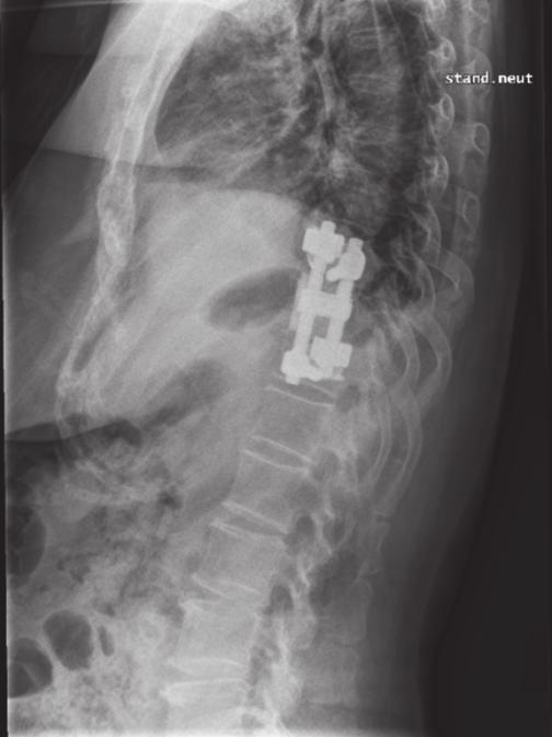 Preoperative simple lateral radiograph (a), T2 weighted sagittal MRI
