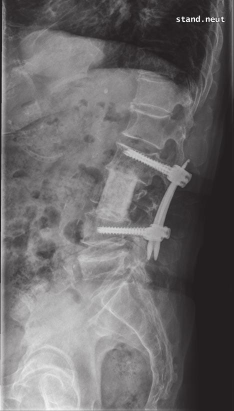surgery for treatment of delayed collapse of osteoporotic vertebral fractures with spinal, seven patients for complications following vertebroplasty, and one