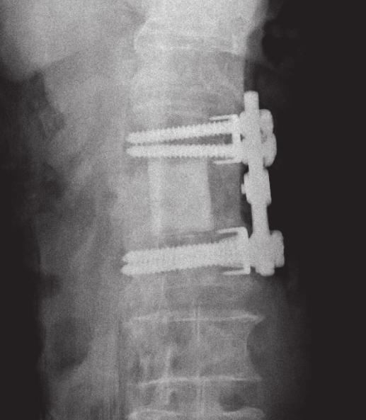 BioMed Research International 7 (a) (b) (c) (d) Figure 5: Marked progression of kyphosis of the construct related to loosening of screw fixation and without notable subsidence or penetration of the