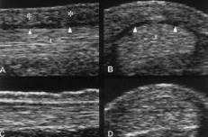 Ultrasound in joint and tendon