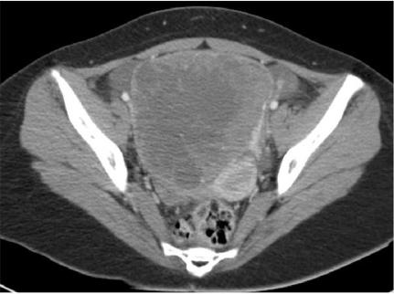 Malignant 2013 Rhabdoid Accomplishments Tumor of Ovary is Characterized